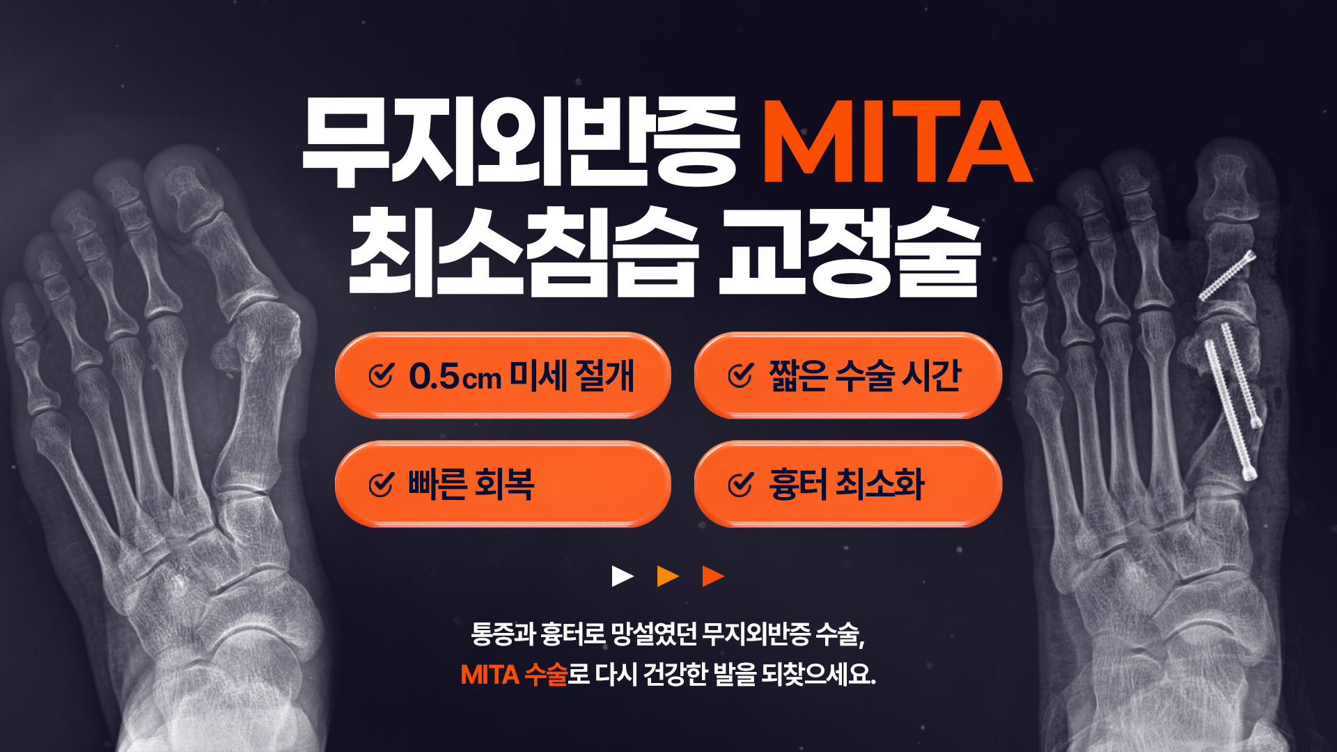 무지외반증
MITA수술