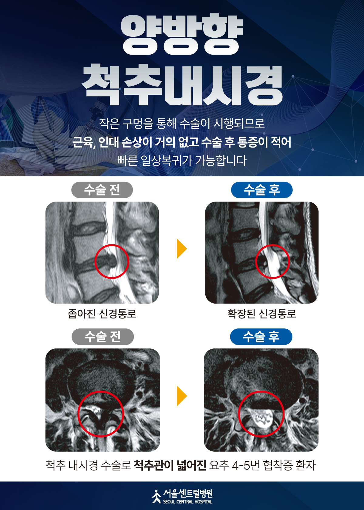 양방향
척추내시경 수술